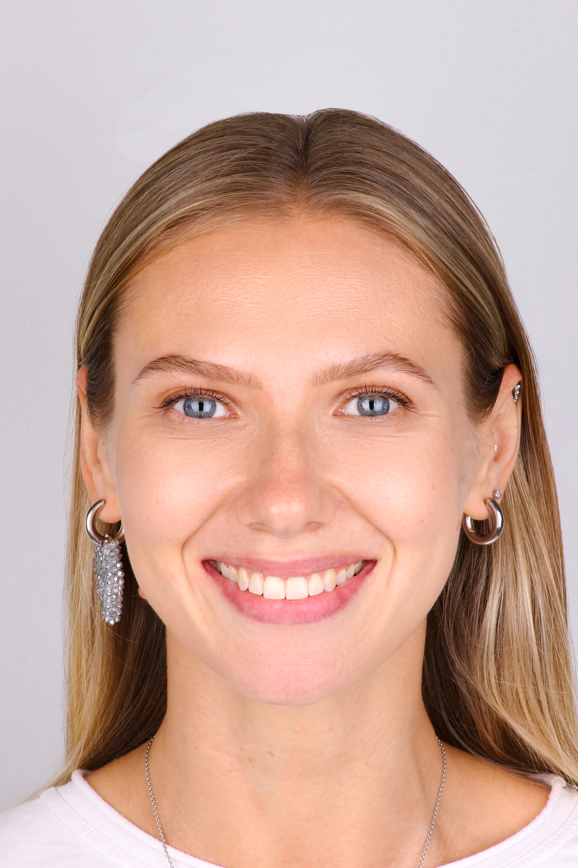 Кейс Саниной - после лечения